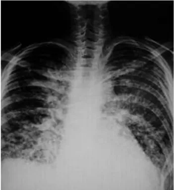 Figura 1 . Tele de tórax: infiltrado bilateral micronódular e infiltración 