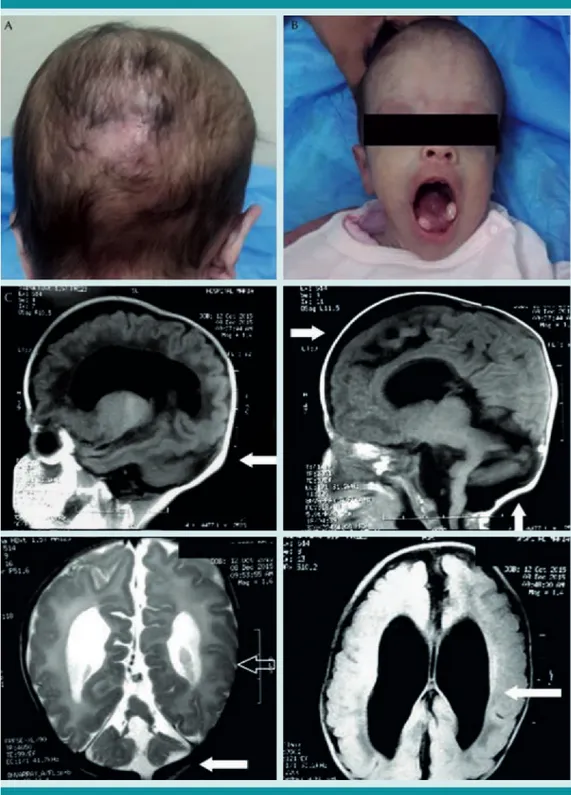Figura 1. A)  Cicatriz secundaria a exéresis de meningoencefalocele.  B)  Lengua con quistes, hamartoma  bilateral y perímetro cefálico de 36 cm a los 4 meses de edad