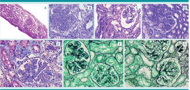 Figura 1.  Biopsia renal:  A)  Vista panorámica.  B)  Patrón membranoproliferativo caracterizado  por engrosamiento 