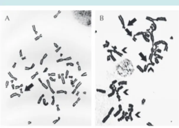Figura 2.  Aberraciones cromosómicas inducidas por  la  mitomicina-C  en  linfocitos  de  sangre  periférica