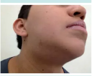 Figura 1.  Submandibular derecho.