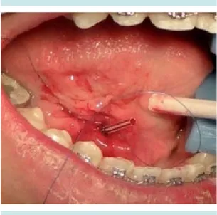 Figura 6.   Infiltración  anestésica  para  la  realización  de litectomía.