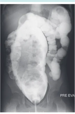 Figura 1.  Enema con contraste que muestra un recto  de  gran  tamaño  en  un  paciente  con  estreñimiento  funcional.