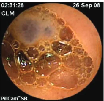 Figura 2. Se observa el hemangioma.