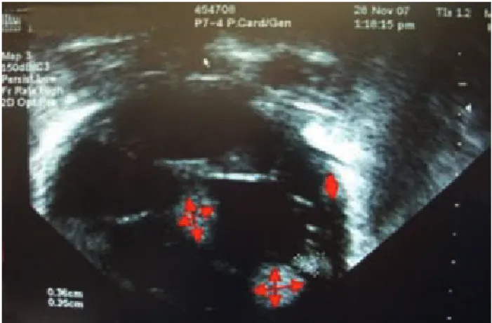 Figura 2. Ecocardiograma realizado al mes de su ingreso, en el que  se ven los rabdomiomas en el ventrículo izquierdo; no hay datos  de obstrucción de la vía de salida del ventrículo.
