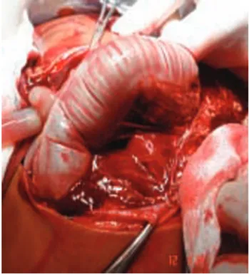 Figura 4. Hemoperitoneo.