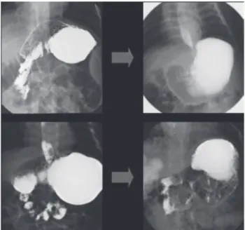 Figura 3. Serie esófago-gastro-duodenal pre y postoperatoria. a la pared abdominal con dos puntos separados de sutura 3-0 no absorbible.