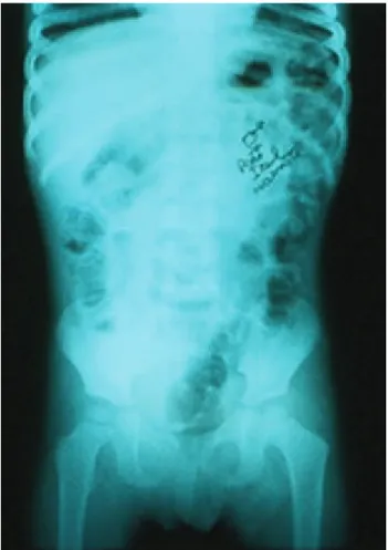 Figura 1. Este estudio radiológico simple de abdomen en posición 