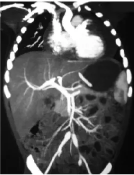 Figura 12. Angiotomografía que muestra aneurisma de arterias