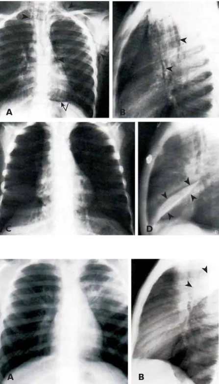 Figura 5. Neumonía. (A) Radiografía AP de 