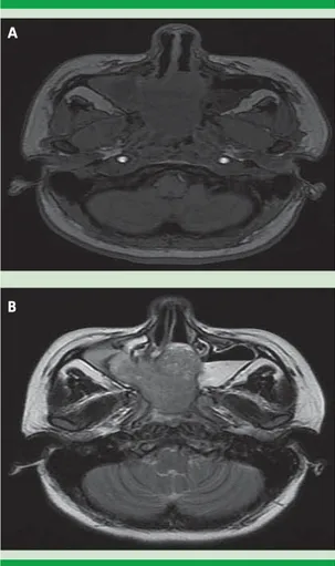 Figura 4.  Estudio de resonancia magnética en T1 ( A) y T2 ( B)  que muestra lesión tumoral lobulada, hete rogénea, isointensa en T1 e hiperintensa al mismo  en T2 que ocupa la totalidad de la cavidad nasal y la  nasofaringe con destrucción del tabique na