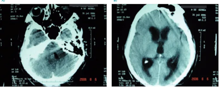 Figura 1. Tomografía inicial simple de cráneo. A) En el lado derecho nótese la completa ocupación de las celdillas mastoideas y en el lado izquierdo  nótese una neumatización normal