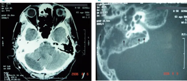 Figura 2. Estudios de imagen posteriores a la colocación de una válvula ventriculoperitoneal