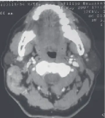 Figura 2. TC de oído, corte coronal; oído medio. Figura 3. TC contrastada de cuello, corte axial; piso de la boca.