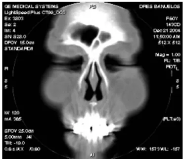 Figura 6. Caso 2. Perforación septal. 