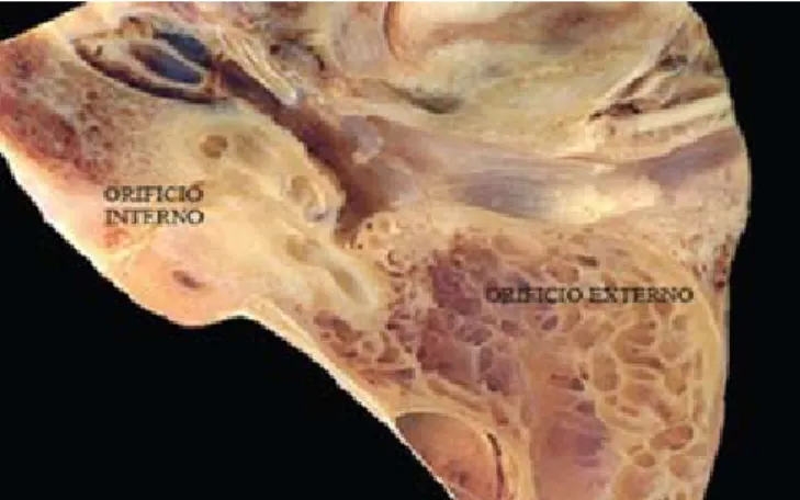 Figura 1. Porción ósea del conducto auditivo externo. Tomado de: Brodie  H, et al. Interactive temporal bone anatomy;
