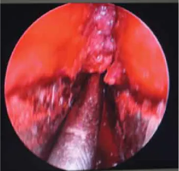 Figura  3.  Imagen  endoscópica  de  la  fosa  nasal  derecha.  Lesión  violácea, 