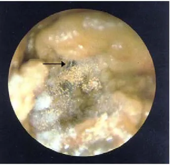 Figura 2.  Otomicosis. La luz del conducto está llena de exudado