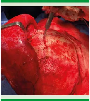 Figura 4.  Endoscopia nasal derecha que muestra dre- dre-naje permeable del seno frontal.