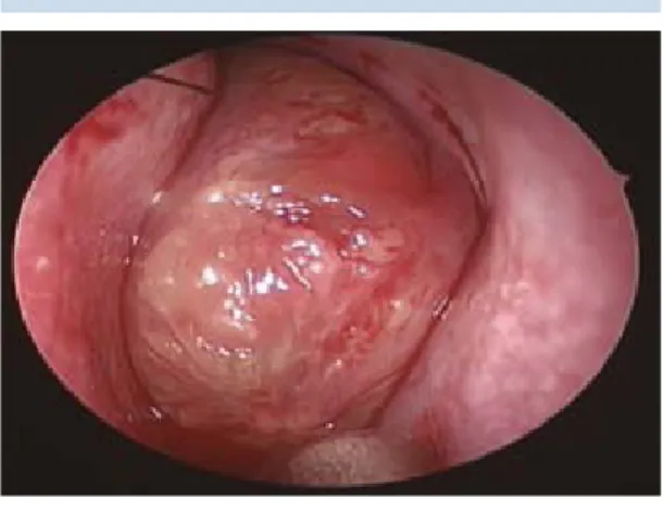 Figura 1.  Endoscopia nasal.