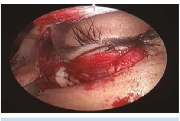 Figura 6.  Rinotomía lateral con extensión subciliar.