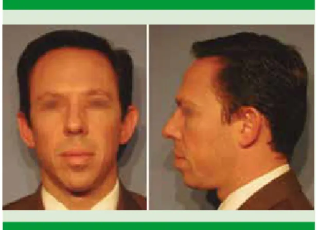 Figura 2. Tomografía computada preoperatoria (corte  axial [A] y coronal [B]).