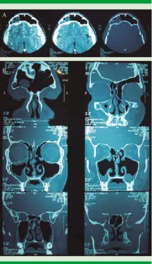 Figura 8. Tomografía computada preoperatoria (corte  axial [A] y coronal [B]).