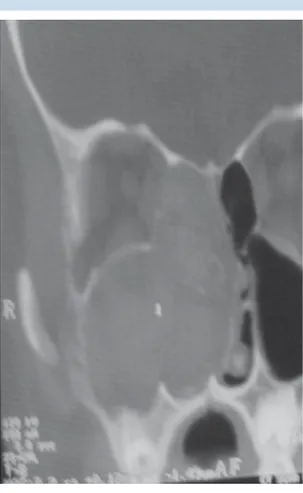 Figura 5.  Producto quirúrgico macroscópico de mi- mi-cetoma del seno maxilar.