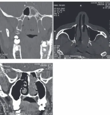 Figura 3. Pieza quirúrgica resecada en bloque por medio de endoscopia.
