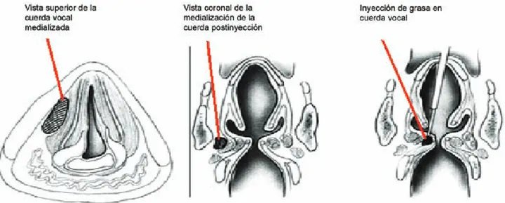 Figura 1. De izquierda a derecha, inyección de grasa en la cuerda vocal paralizada y grado de compensación alcanzado con la aplicación de la grasa