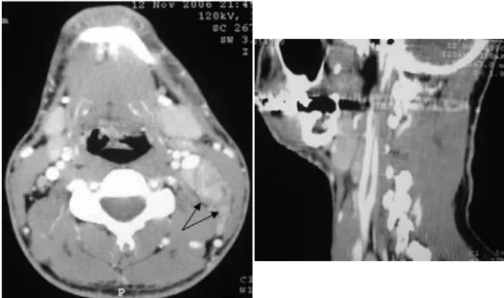 Figura  1.  Cortes  comparativos  de  tomografía  computarizada  de  cuello, 