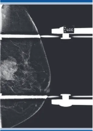 Figura 2.  Proyección aumentada de la lesión en la  imagen  1B .