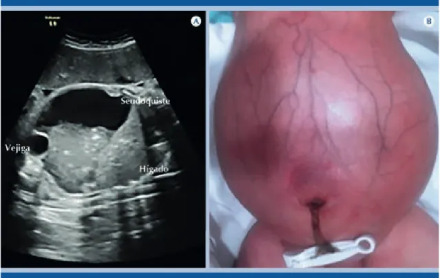 Figura 1. A)  Ultrasonido prenatal a las 37 semanas de gestación: por debajo del hígado, masa quística con ecos  densos en su interior que se depositan hacia la parte más declive y que comprime la vejiga
