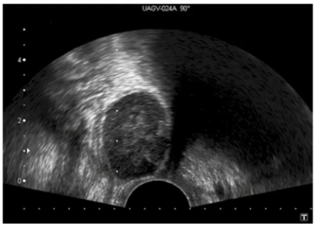 Figura 1. Ecografía endovaginal: lesión nodular, bien  delimitada, hipoecoica y homogénea en contacto con  la pared vaginal.