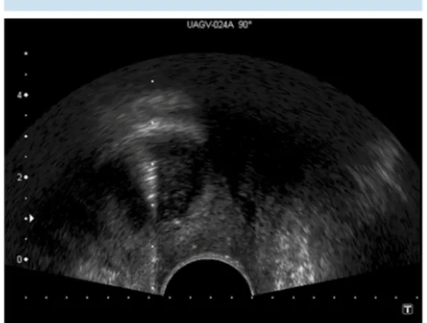 Figura 3. Ecografía endovaginal: aguja de biopsia en  el interior de la lesión nodular de la que se obtuvieron  dos cilindros para estudio anatomopatológico.