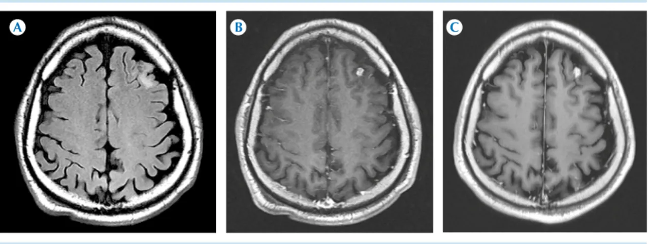 Figura 2. A-B)  Resonancia en secuencias FLAIR y T1 contrastada: metástasis con realce heterogéneo y edema  perilesional