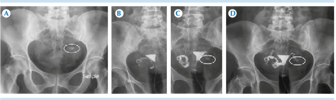 Figura 1. A)  Proyección preliminar simple de pelvis: calcificación gruesa (circulo) localizada en hueco pélvico  que tras la administración de medio de contraste se localiza en la topografía ovárica izquierda en relación con  componente cálcico de tumorac