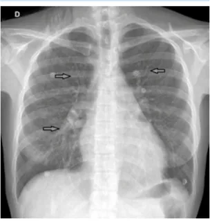 Figura 1.  Radiografía posteroanterior de tórax con  prominencia hiliar bilateral y patrón reticulonodular.