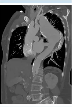 Figura 13.   Mujer  de  59  años  con  historia  de  dolor  epigástrico progresivo que muestra placas de ateroma  calcificadas en el trayecto aórtico y dilatación  aneu-rismática después del origen de la subclavia izquierda  en tomografía de urgencias.