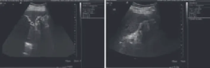 Figura 1. Ultrasonido de abdomen donde se identifica un  quiste  hepático  con  pared  calcificada  que  mide  2.7  cm