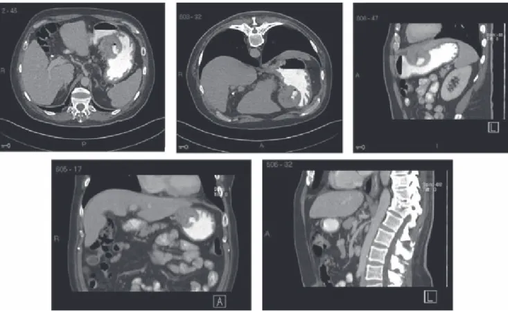 Figura 3. TC de abdomen con contraste oral y endovenoso. Se identifican imágenes hepáticas hipodensas compatibles con  metástasis