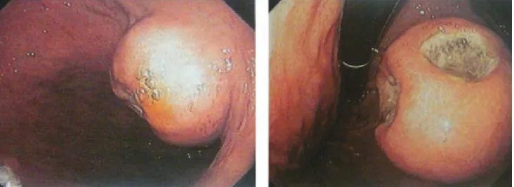 Figura 4. Imágenes endoscópicas donde se observa una lesión polipoide, esférica, con presencia de dos imágenes de  aspecto ulcerado en el fondo gástrico.