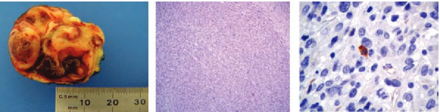 Figura 16. Imagen de pieza macroscópica, vista microscópica (panorámico y 40x) donde se observa una lesión fusocelular,  sin datos de necrosis
