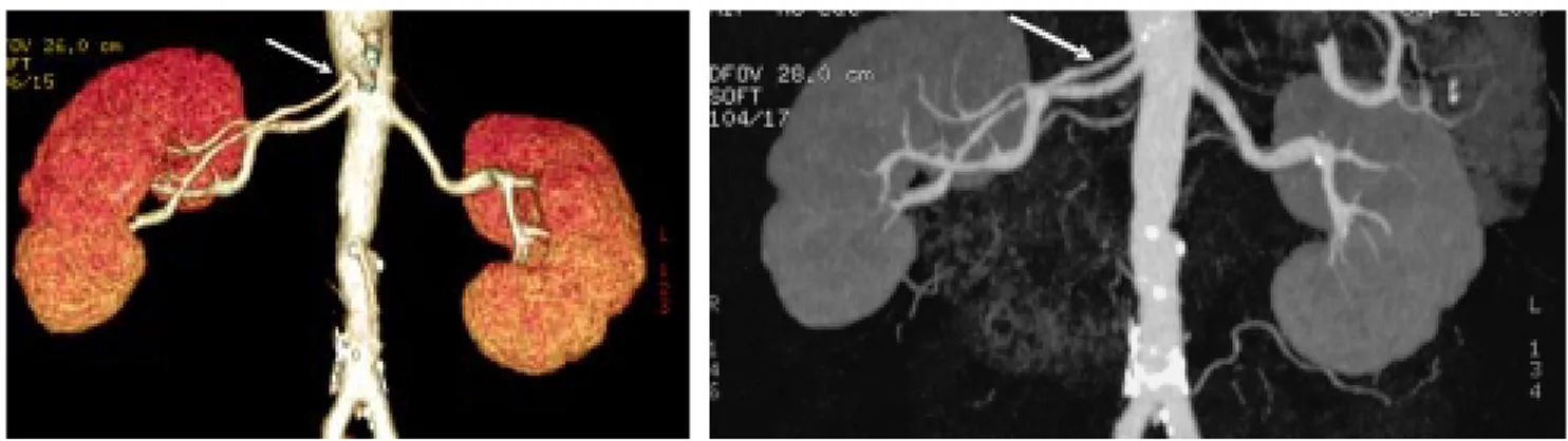 Figura 14. Ejemplo de VAV 8: Imágenes MIP coronales y reconstrucción 3D que muestran arteria renal polar inferior izquierda