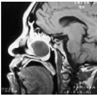 Figura 6. Mucocele esfenoidal.
