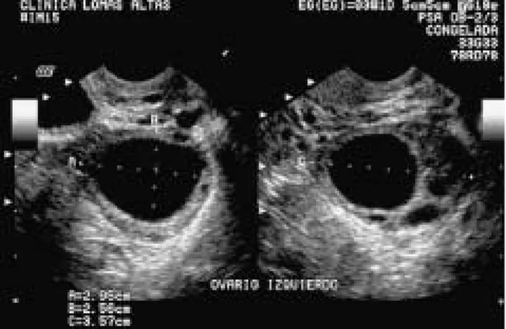 Figura 1. Folículo del ovario: Imagen quística de bordes bien