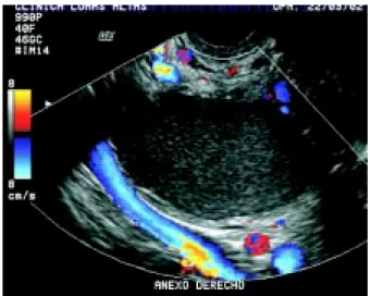 Figura 4. Endometrioma: A)
