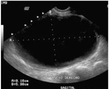 Figura 10. Neoplasia benigna del ovario que histológicamente correspondió a un cistoadenoma mucinoso: A) Masa quística