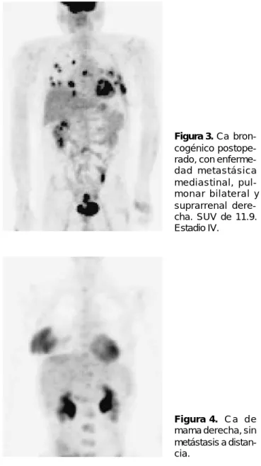 Figura 2.  Nódulo pul-