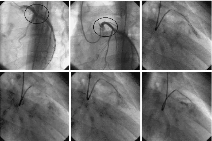 Figura 5. (A, B, C). Se muestran diferentes horas de monitoreo electrocardiográfico con presencia de desniveles ST sobre